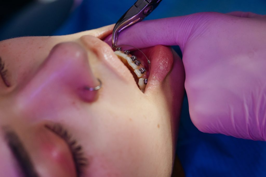 Should I Use a Retainer for Teeth Straightening?